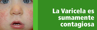 La Varicela es sumamente contagiosa