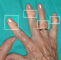 Artritis Reumatoide